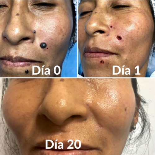 Eliminaci�n de lunares